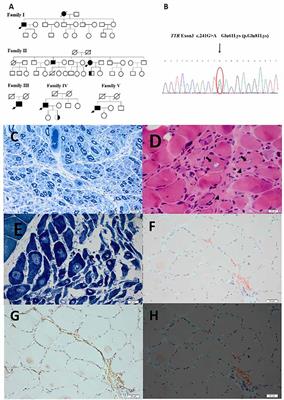 Clinical and biochemical characterization of hereditary transthyretin amyloidosis caused by E61K mutation